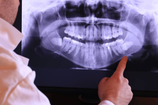 Best Emergency Wisdom Teeth Removal in Oakhurst, NJ