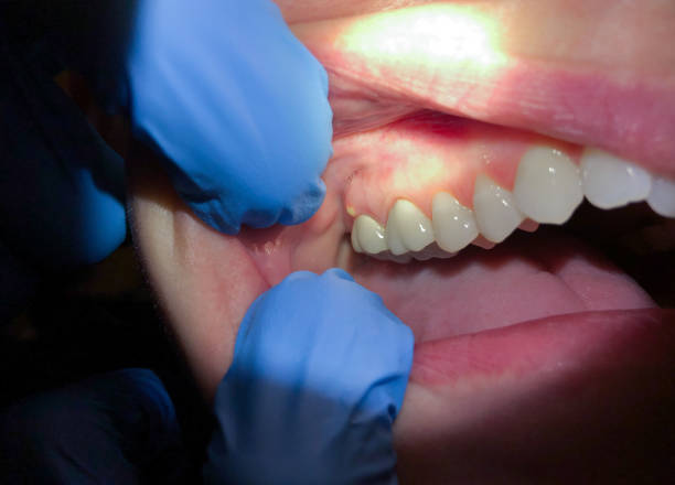 Best Emergency Wisdom Teeth Removal in Oakhurst, NJ
